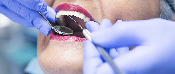 Best Knocked-Out Tooth (Avulsed Tooth) Treatment in Morris, IL